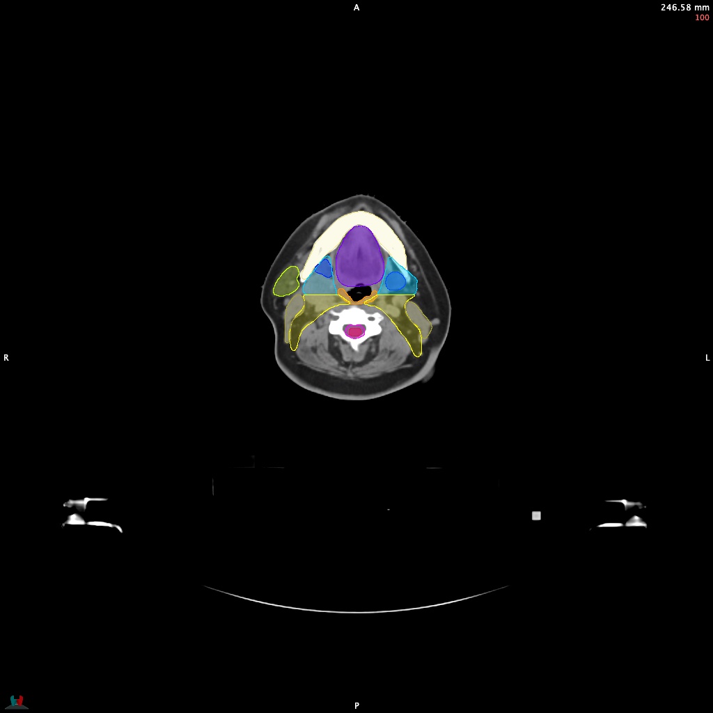 Automatic Contouring/Segmentation Demo