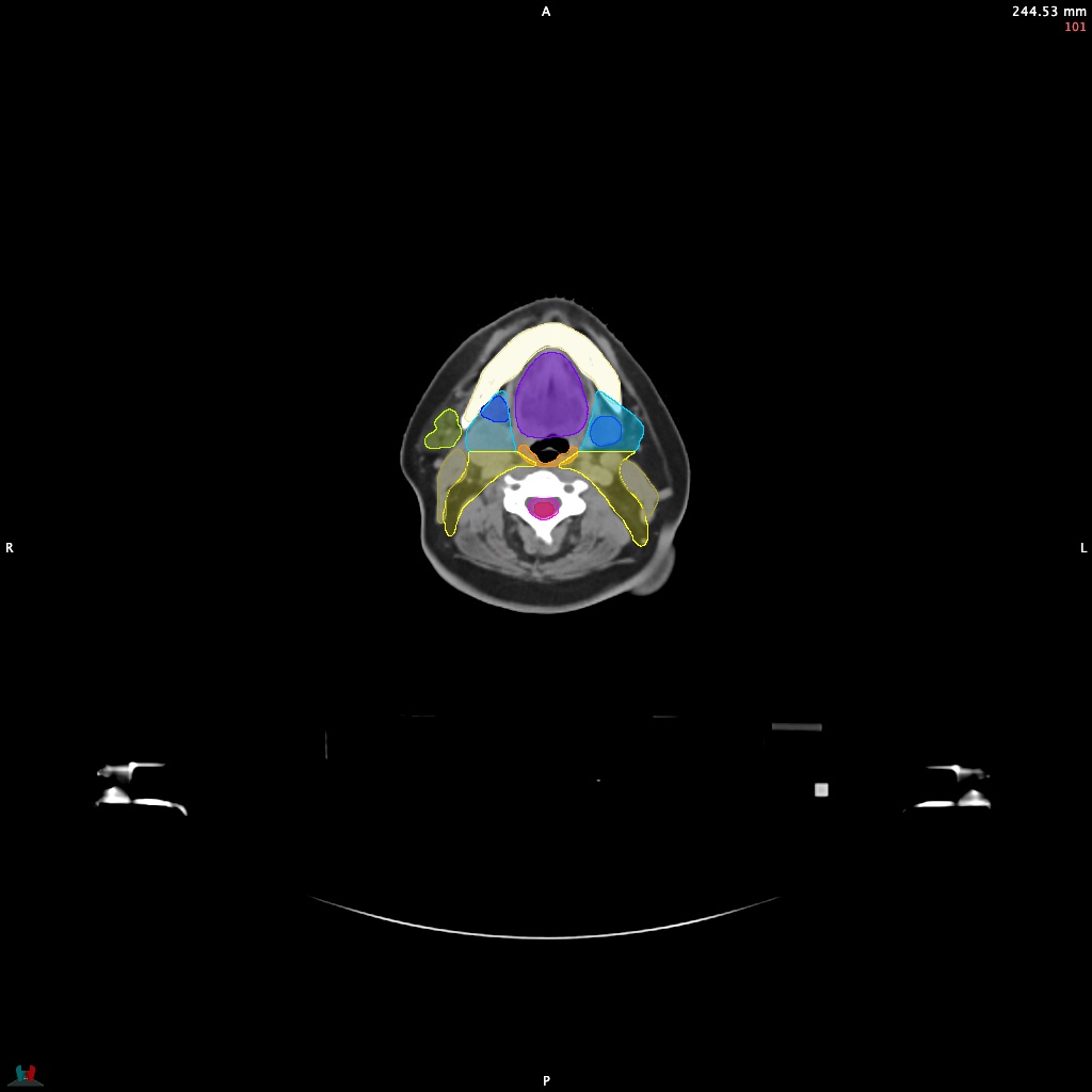 Automatic Contouring/Segmentation Demo