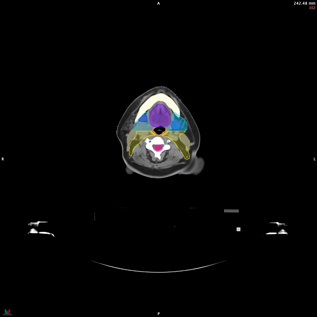 Automatic Contouring/Segmentation Demo
