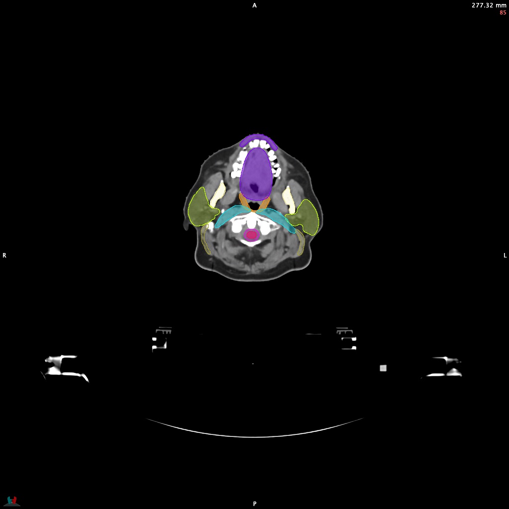 Automatic Contouring/Segmentation Demo