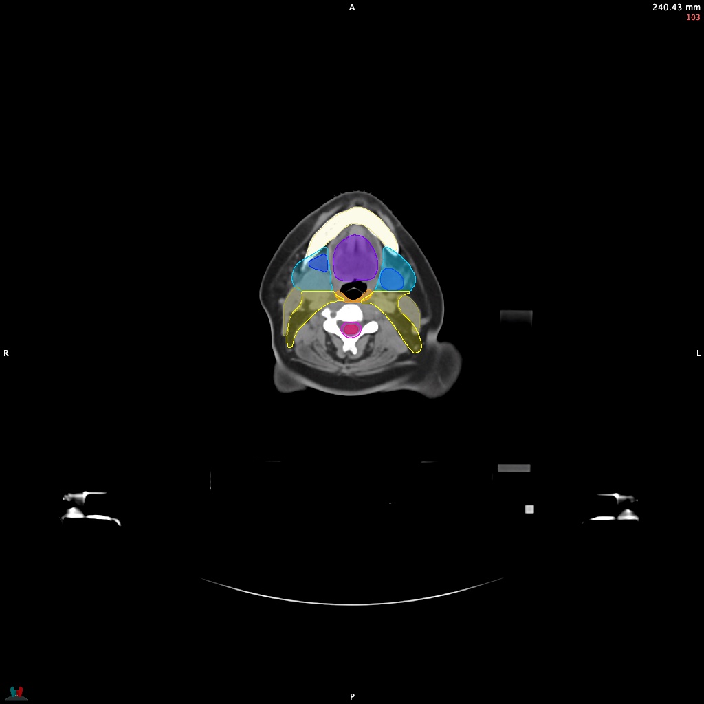Automatic Contouring/Segmentation Demo