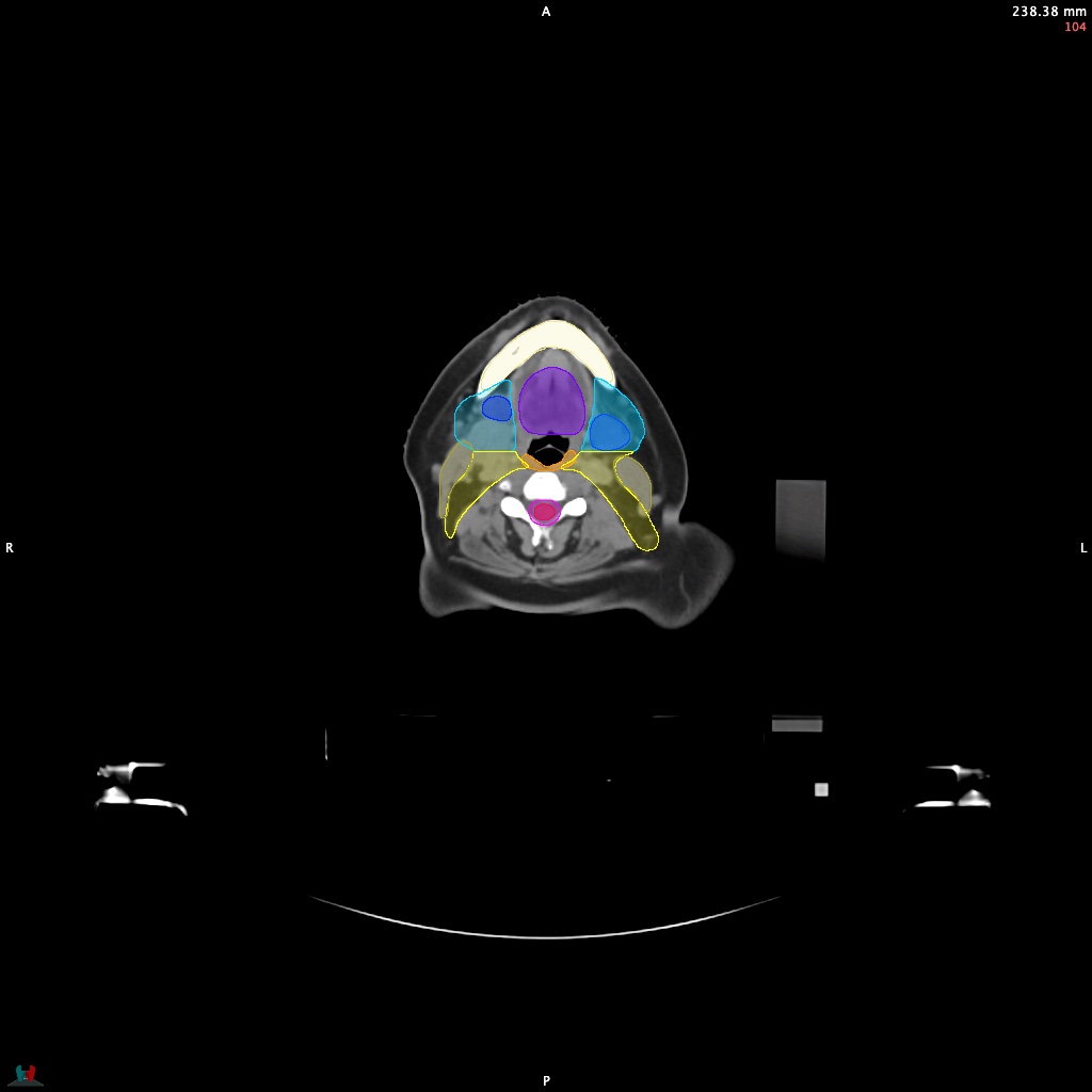 Automatic Contouring/Segmentation Demo