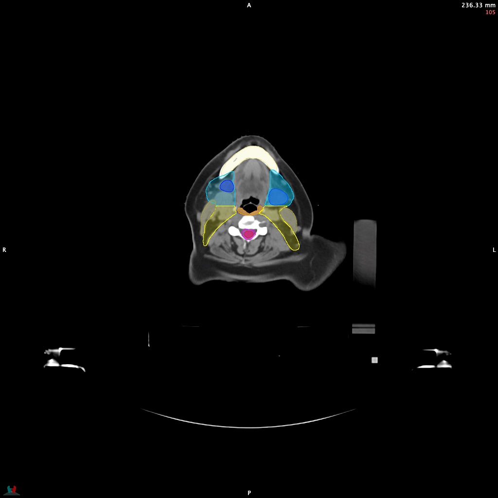 Automatic Contouring/Segmentation Demo