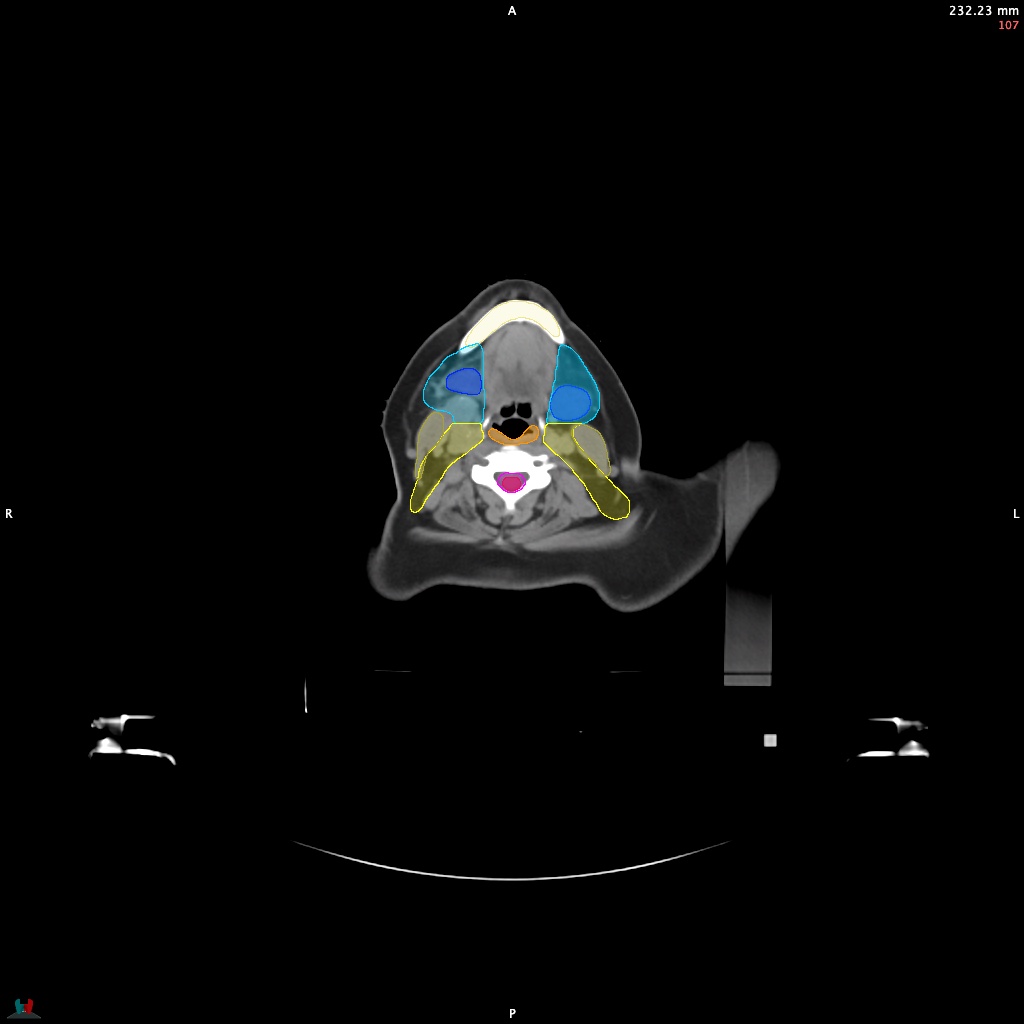 Automatic Contouring/Segmentation Demo
