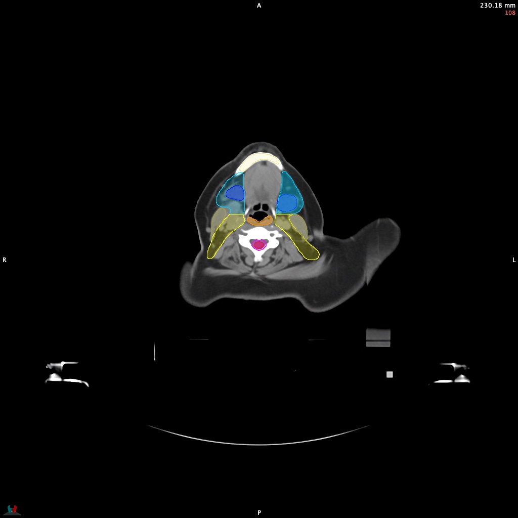 Automatic Contouring/Segmentation Demo