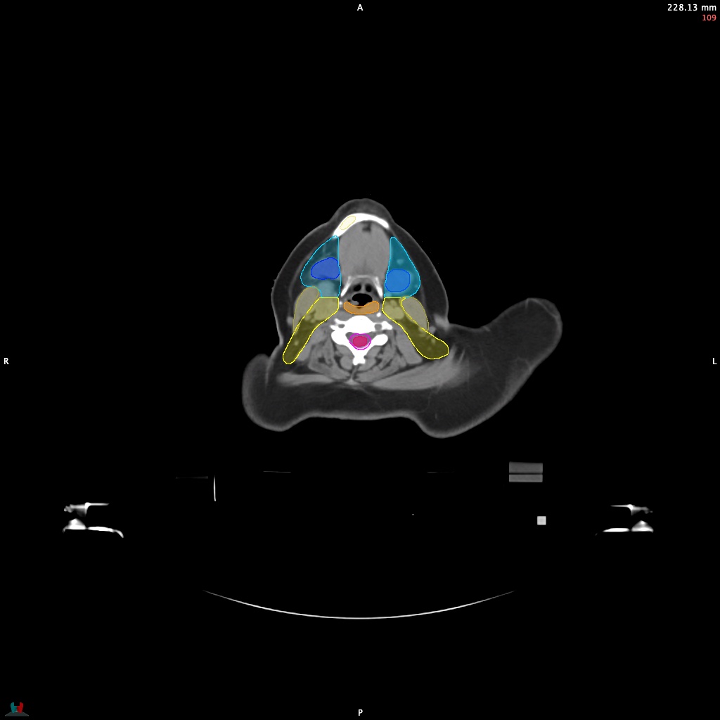 Automatic Contouring/Segmentation Demo