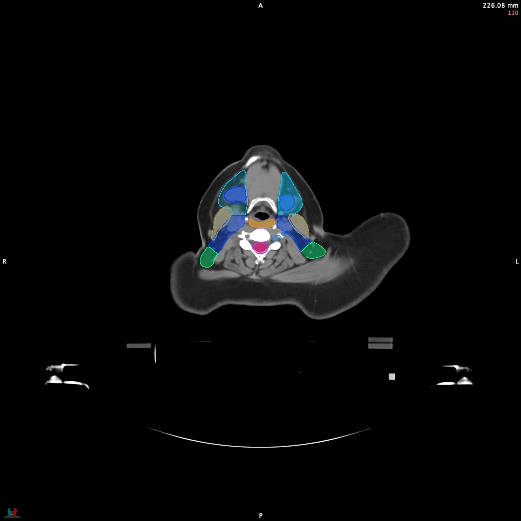 Automatic Contouring/Segmentation Demo