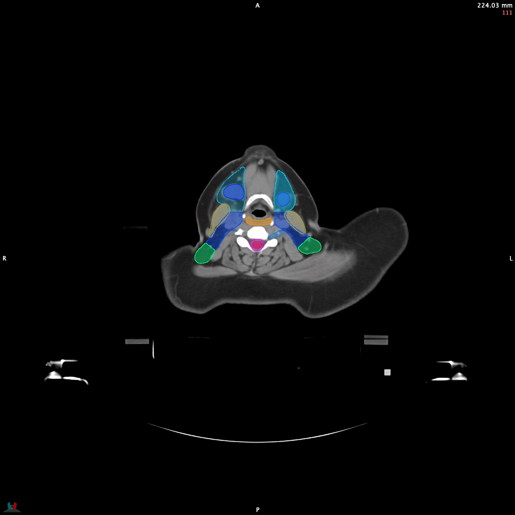 Automatic Contouring/Segmentation Demo