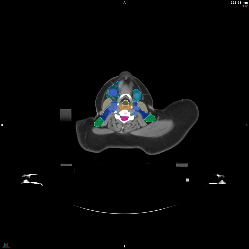 Automatic Contouring/Segmentation Demo