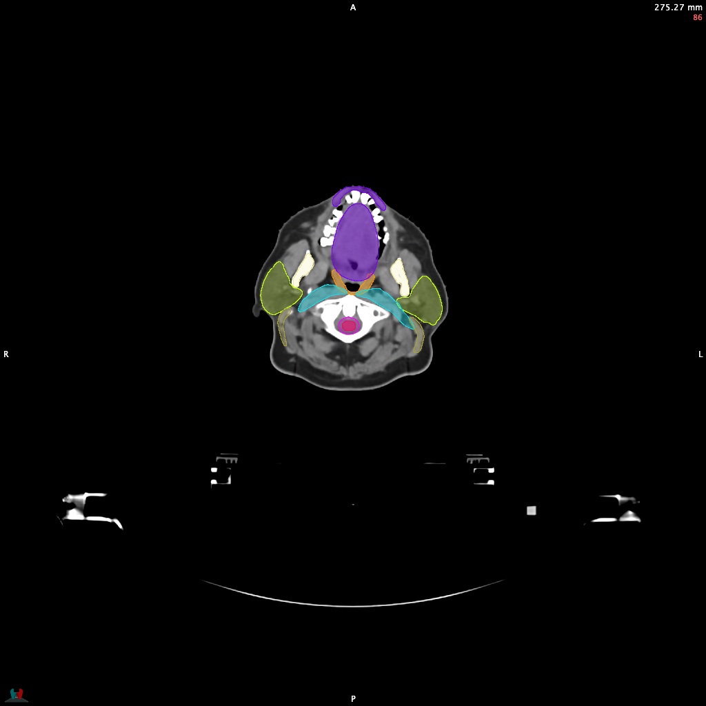 Automatic Contouring/Segmentation Demo
