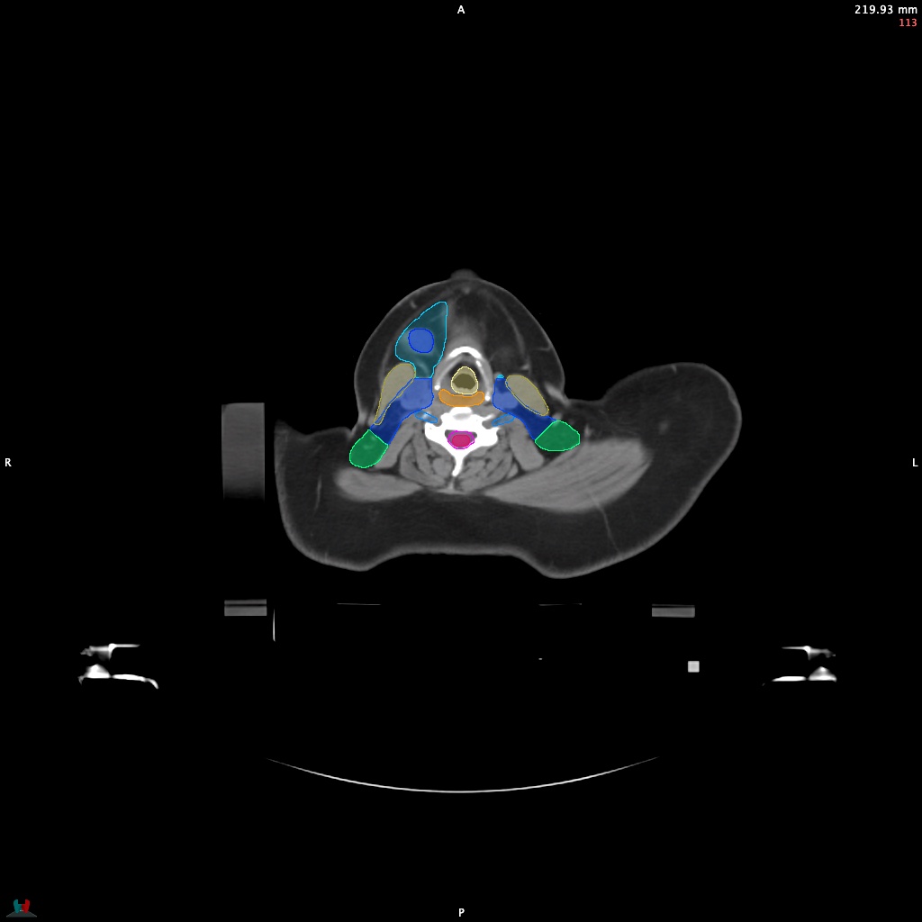 Automatic Contouring/Segmentation Demo