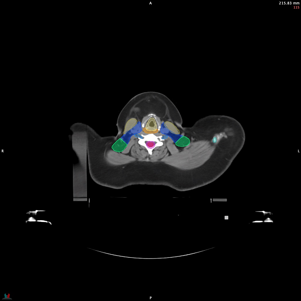Automatic Contouring/Segmentation Demo