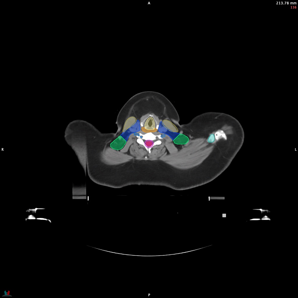 Automatic Contouring/Segmentation Demo