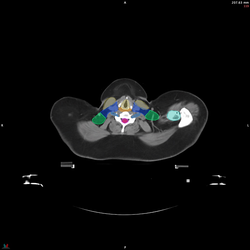 Automatic Contouring/Segmentation Demo