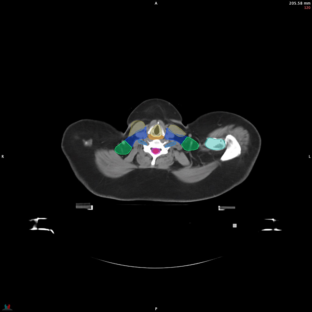 Automatic Contouring/Segmentation Demo