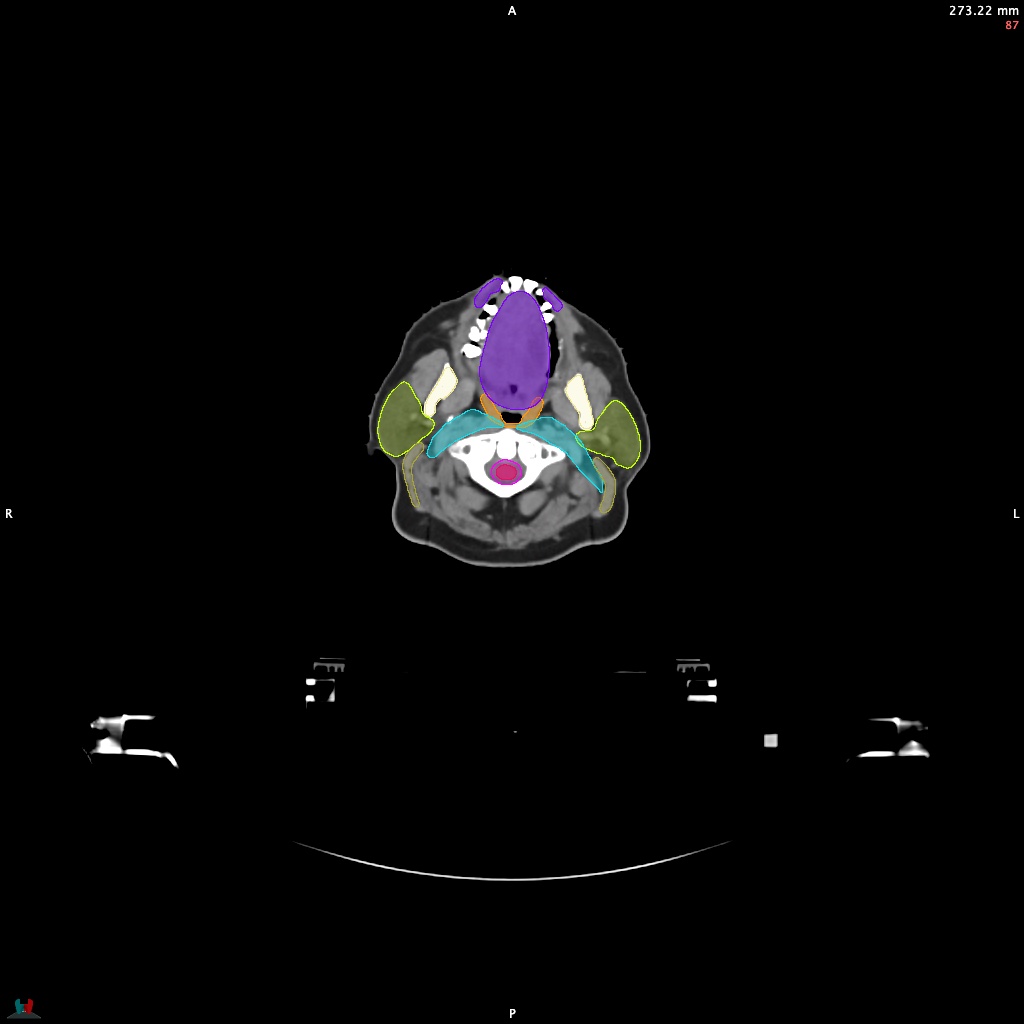 Automatic Contouring/Segmentation Demo