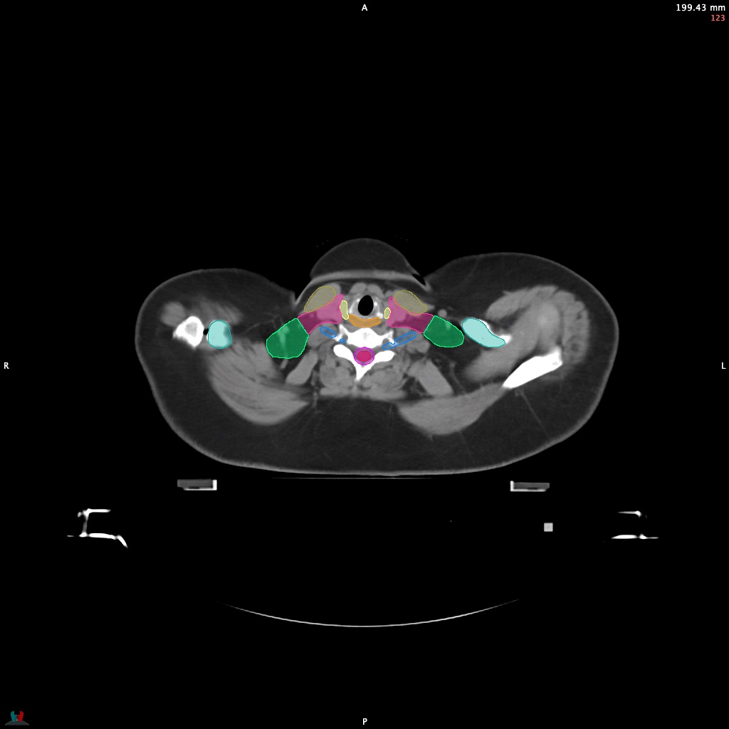 Automatic Contouring/Segmentation Demo