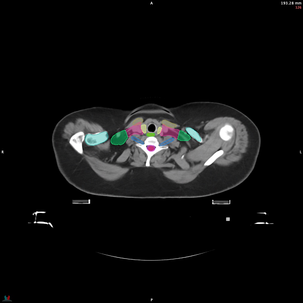 Automatic Contouring/Segmentation Demo