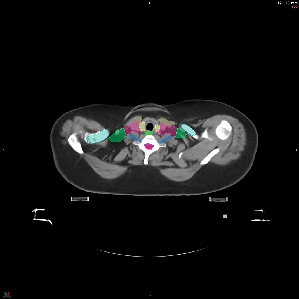 Automatic Contouring/Segmentation Demo