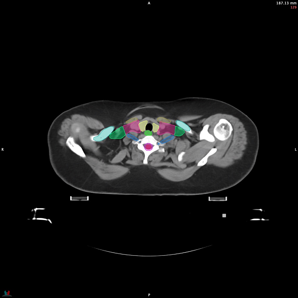 Automatic Contouring/Segmentation Demo