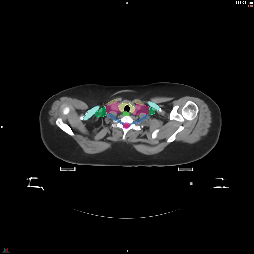 Automatic Contouring/Segmentation Demo