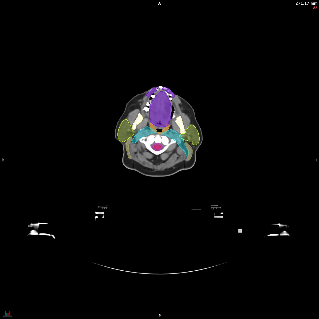 Automatic Contouring/Segmentation Demo