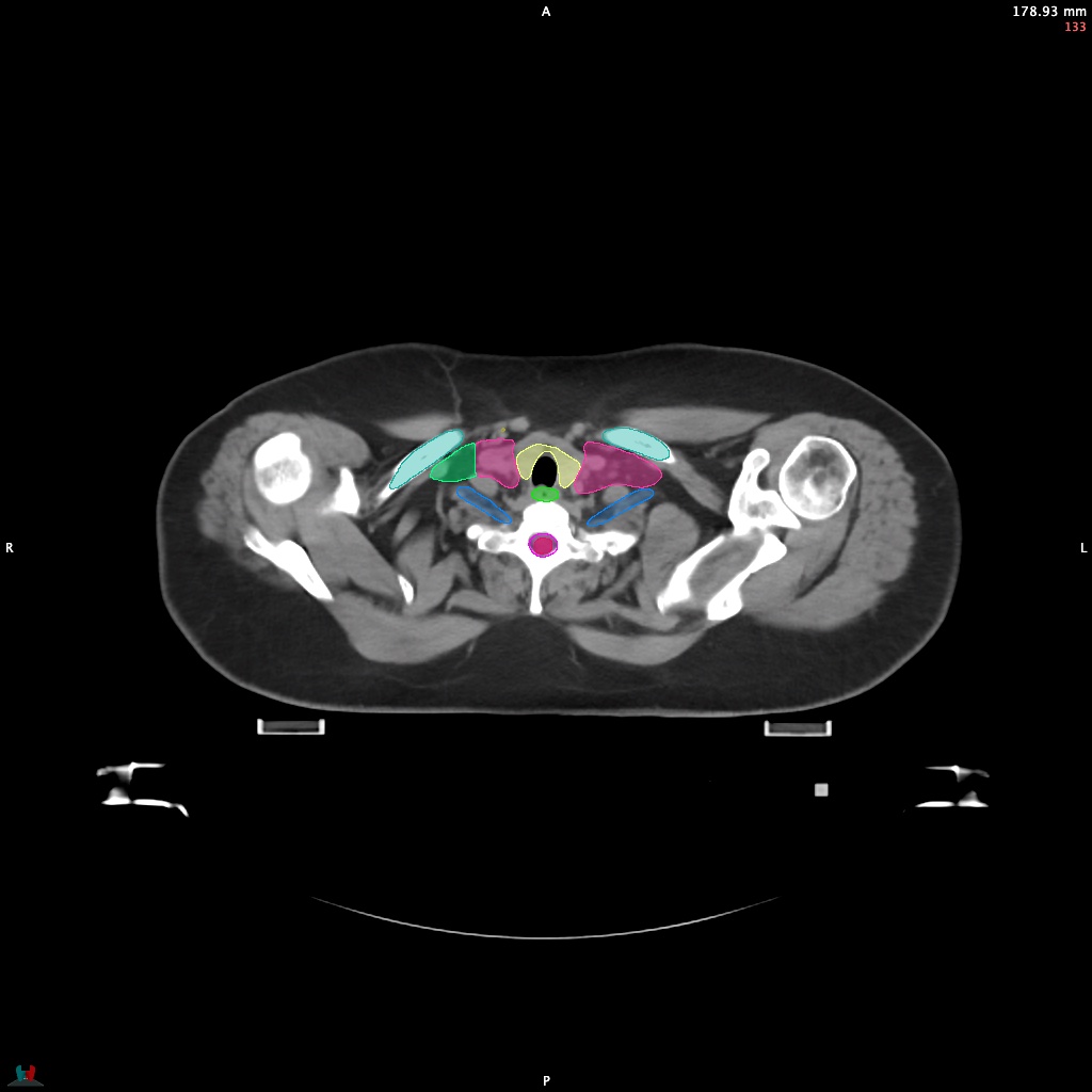Automatic Contouring/Segmentation Demo