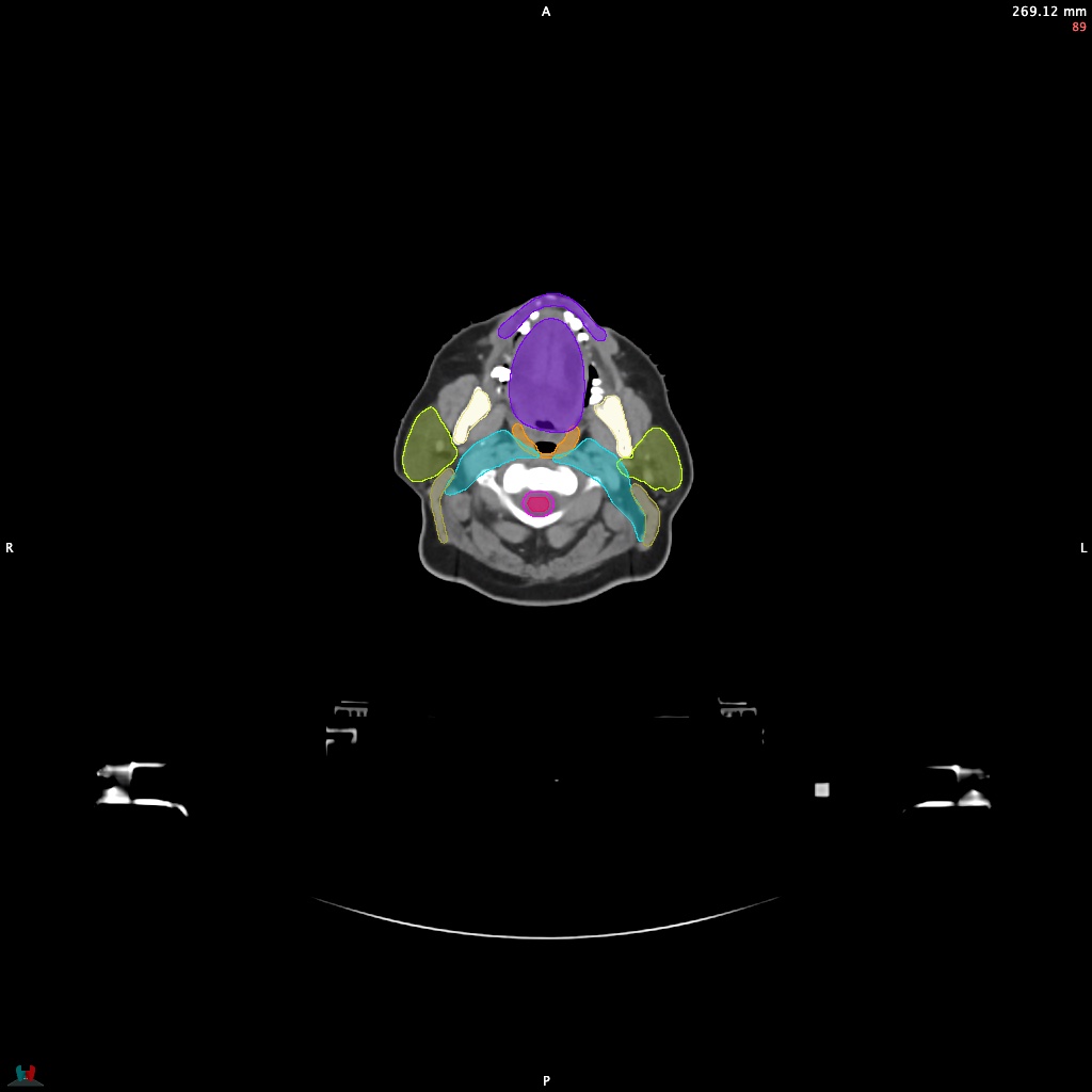 Automatic Contouring/Segmentation Demo
