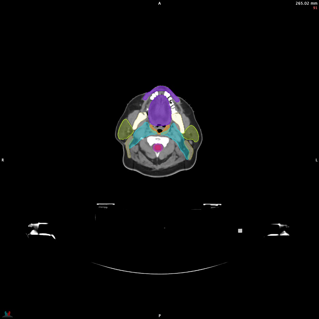 Automatic Contouring/Segmentation Demo