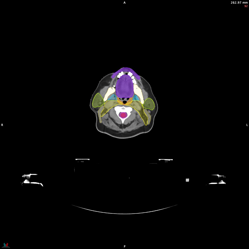 Automatic Contouring/Segmentation Demo
